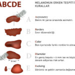 melanomun-erken-tespiti-icin-kurallar-abcde