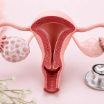 polikistik-over-sendromu-pcos-pkos